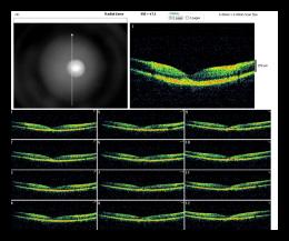 RADIAL LINE OD